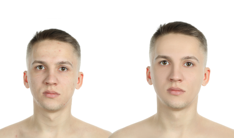 Essential Steps to Manage Troubled Skin